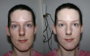 soin lifting coreen brumerisation avant apres.