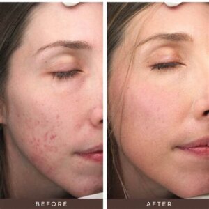 traitement lifting coréen avant après